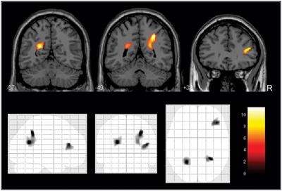 Prefrontal-Parietal White Matter Volumes in Healthy Elderlies Are Decreased in Proportion to the Degree of Cardiovascular Risk and Related to <mark class="highlighted">Inhibitory Control Deficits</mark>
